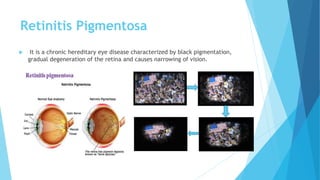 Retinitis Pigmentosa
 It is a chronic hereditary eye disease characterized by black pigmentation,
gradual degeneration of the retina and causes narrowing of vision.
 