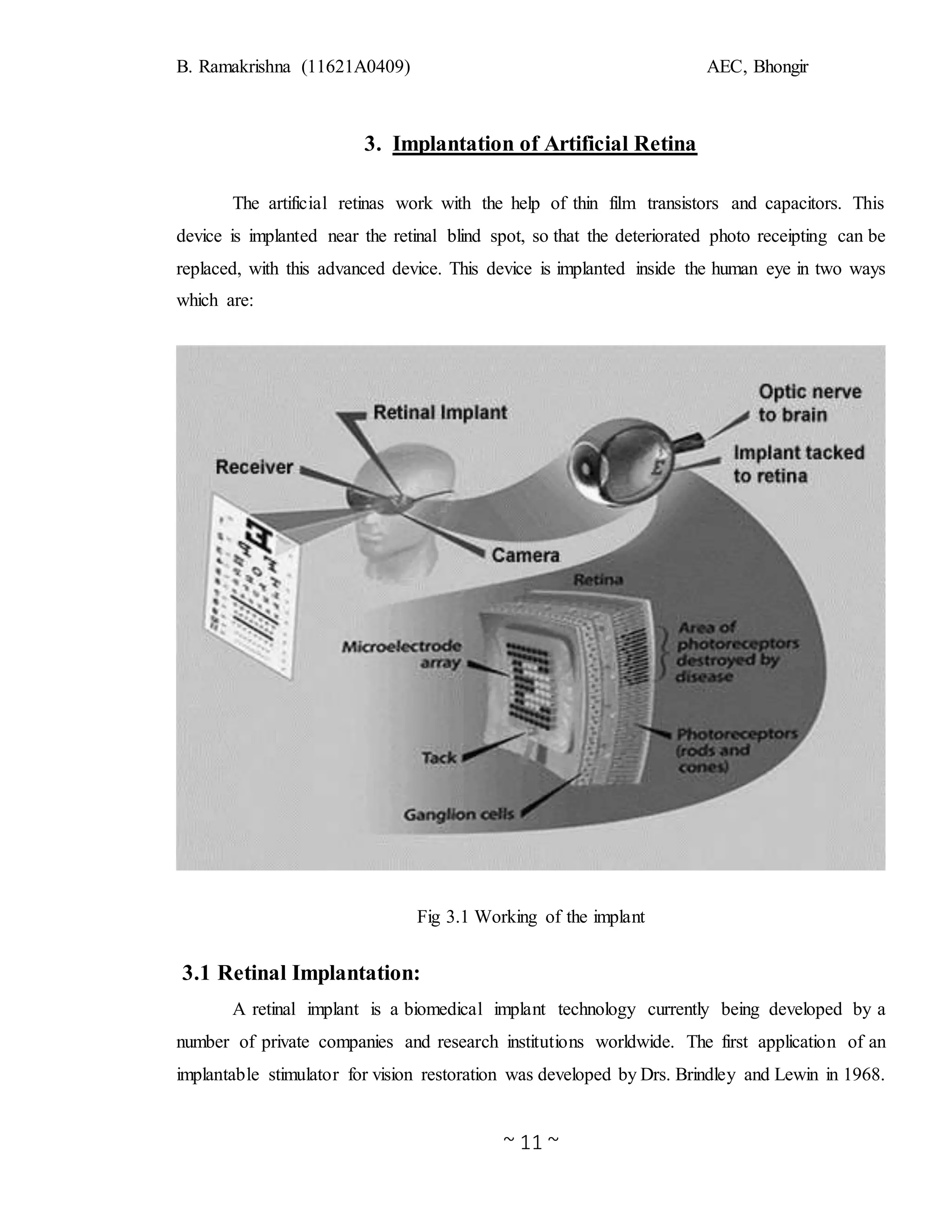 B. Ramakrishna (11621A0409) AEC, Bhongir
~ 11 ~
3. Implantation of Artificial Retina
The artificial retinas work with the help of thin film transistors and capacitors. This
device is implanted near the retinal blind spot, so that the deteriorated photo receipting can be
replaced, with this advanced device. This device is implanted inside the human eye in two ways
which are:
Fig 3.1 Working of the implant
3.1 Retinal Implantation:
A retinal implant is a biomedical implant technology currently being developed by a
number of private companies and research institutions worldwide. The first application of an
implantable stimulator for vision restoration was developed by Drs. Brindley and Lewin in 1968.
 