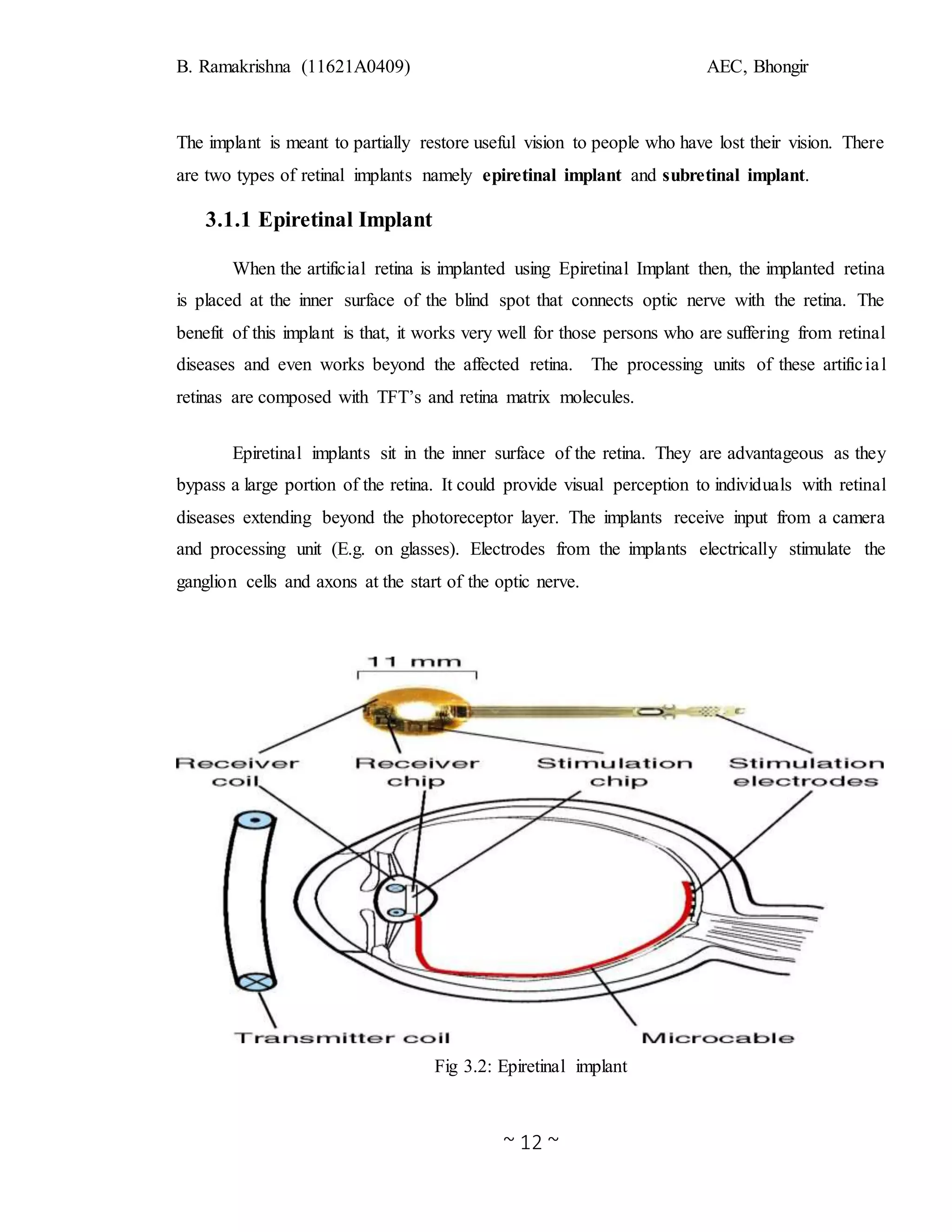 B. Ramakrishna (11621A0409) AEC, Bhongir
~ 12 ~
The implant is meant to partially restore useful vision to people who have lost their vision. There
are two types of retinal implants namely epiretinal implant and subretinal implant.
3.1.1 Epiretinal Implant
When the artificial retina is implanted using Epiretinal Implant then, the implanted retina
is placed at the inner surface of the blind spot that connects optic nerve with the retina. The
benefit of this implant is that, it works very well for those persons who are suffering from retinal
diseases and even works beyond the affected retina. The processing units of these artificial
retinas are composed with TFT’s and retina matrix molecules.
Epiretinal implants sit in the inner surface of the retina. They are advantageous as they
bypass a large portion of the retina. It could provide visual perception to individuals with retinal
diseases extending beyond the photoreceptor layer. The implants receive input from a camera
and processing unit (E.g. on glasses). Electrodes from the implants electrically stimulate the
ganglion cells and axons at the start of the optic nerve.
Fig 3.2: Epiretinal implant
 