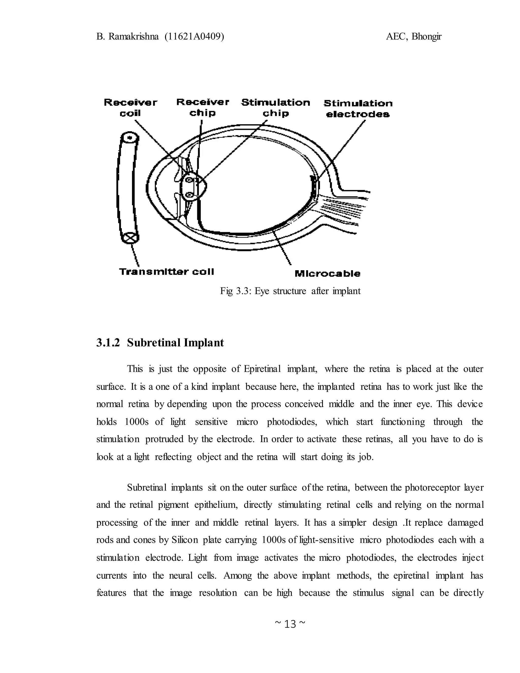 B. Ramakrishna (11621A0409) AEC, Bhongir
~ 13 ~
Fig 3.3: Eye structure after implant
3.1.2 Subretinal Implant
This is just the opposite of Epiretinal implant, where the retina is placed at the outer
surface. It is a one of a kind implant because here, the implanted retina has to work just like the
normal retina by depending upon the process conceived middle and the inner eye. This device
holds 1000s of light sensitive micro photodiodes, which start functioning through the
stimulation protruded by the electrode. In order to activate these retinas, all you have to do is
look at a light reflecting object and the retina will start doing its job.
Subretinal implants sit on the outer surface of the retina, between the photoreceptor layer
and the retinal pigment epithelium, directly stimulating retinal cells and relying on the normal
processing of the inner and middle retinal layers. It has a simpler design .It replace damaged
rods and cones by Silicon plate carrying 1000s of light-sensitive micro photodiodes each with a
stimulation electrode. Light from image activates the micro photodiodes, the electrodes inject
currents into the neural cells. Among the above implant methods, the epiretinal implant has
features that the image resolution can be high because the stimulus signal can be directly
 