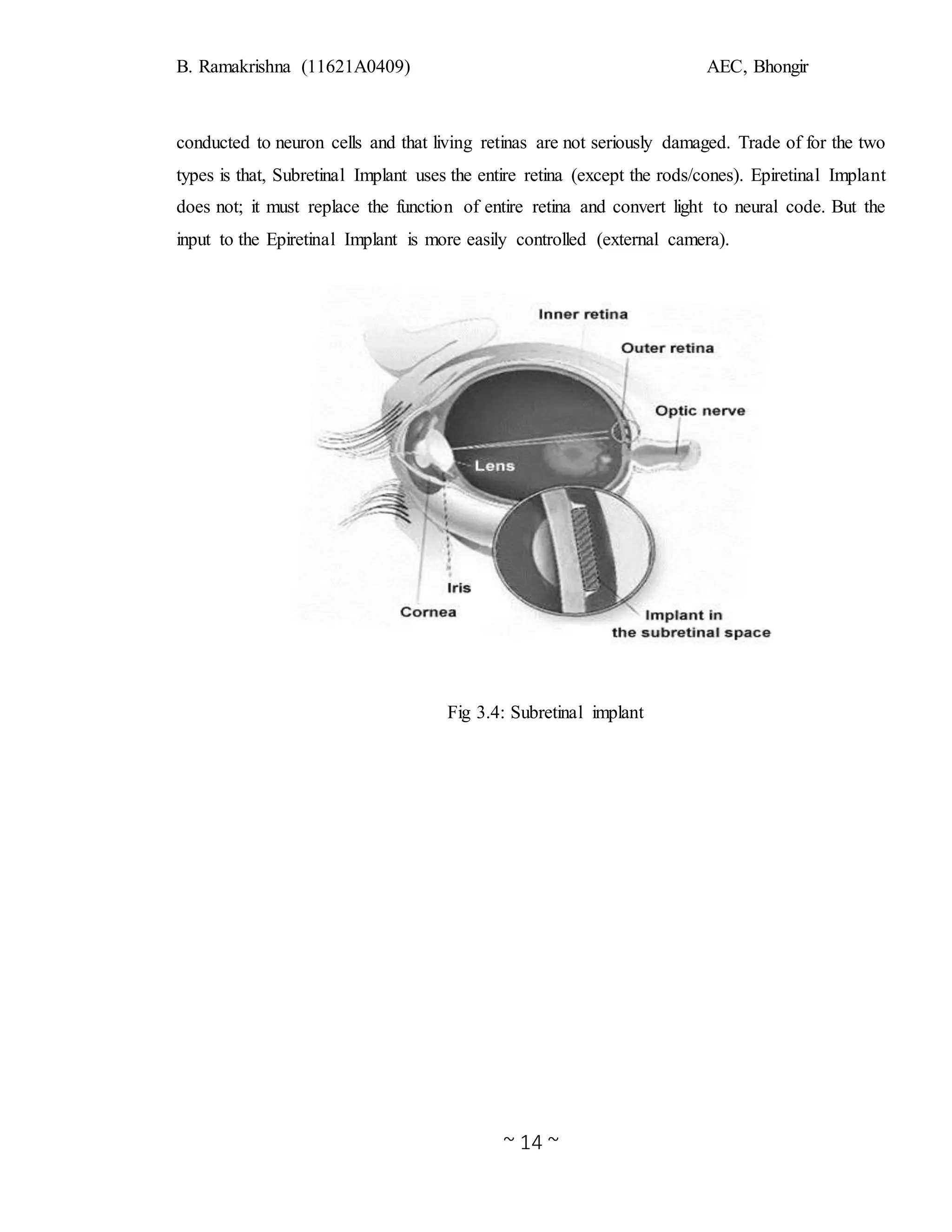 B. Ramakrishna (11621A0409) AEC, Bhongir
~ 14 ~
conducted to neuron cells and that living retinas are not seriously damaged. Trade of for the two
types is that, Subretinal Implant uses the entire retina (except the rods/cones). Epiretinal Implant
does not; it must replace the function of entire retina and convert light to neural code. But the
input to the Epiretinal Implant is more easily controlled (external camera).
Fig 3.4: Subretinal implant
 
