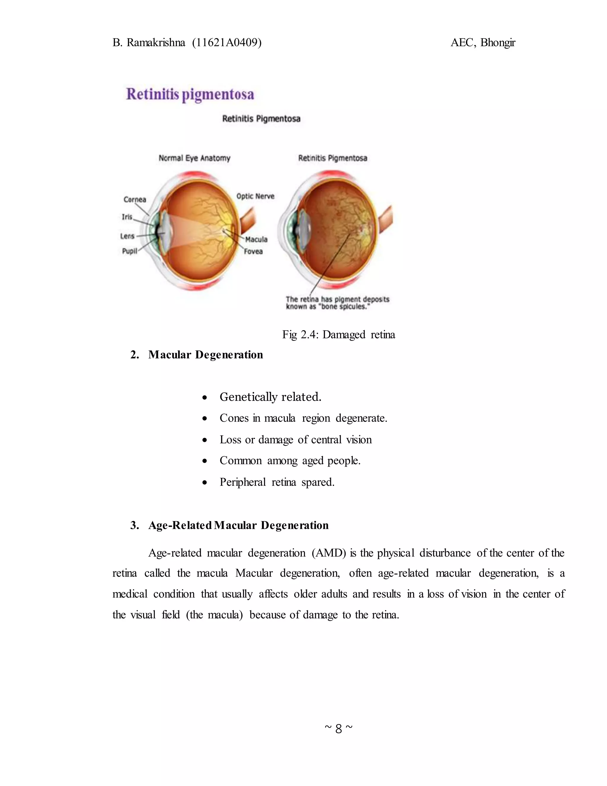 B. Ramakrishna (11621A0409) AEC, Bhongir
~ 8 ~
Fig 2.4: Damaged retina
2. Macular Degeneration
 Genetically related.
 Cones in macula region degenerate.
 Loss or damage of central vision
 Common among aged people.
 Peripheral retina spared.
3. Age-RelatedMacular Degeneration
Age-related macular degeneration (AMD) is the physical disturbance of the center of the
retina called the macula Macular degeneration, often age-related macular degeneration, is a
medical condition that usually affects older adults and results in a loss of vision in the center of
the visual field (the macula) because of damage to the retina.
 