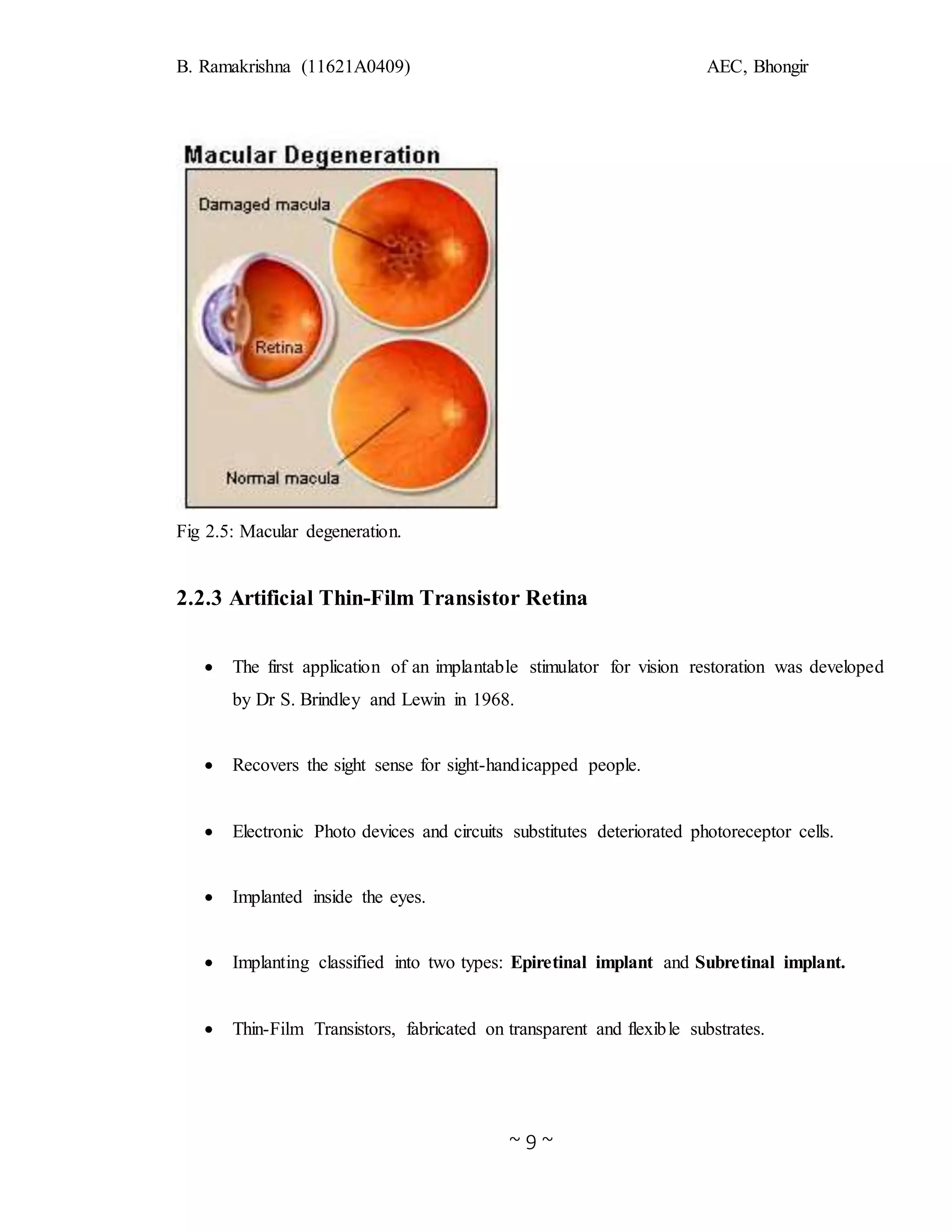 B. Ramakrishna (11621A0409) AEC, Bhongir
~ 9 ~
Fig 2.5: Macular degeneration.
2.2.3 Artificial Thin-Film Transistor Retina
 The first application of an implantable stimulator for vision restoration was developed
by Dr S. Brindley and Lewin in 1968.
 Recovers the sight sense for sight-handicapped people.
 Electronic Photo devices and circuits substitutes deteriorated photoreceptor cells.
 Implanted inside the eyes.
 Implanting classified into two types: Epiretinal implant and Subretinal implant.
 Thin-Film Transistors, fabricated on transparent and flexible substrates.
 