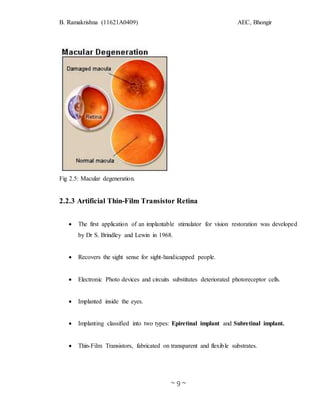 Eye Transistor Artificial retina using thin film transistor report | DOCX