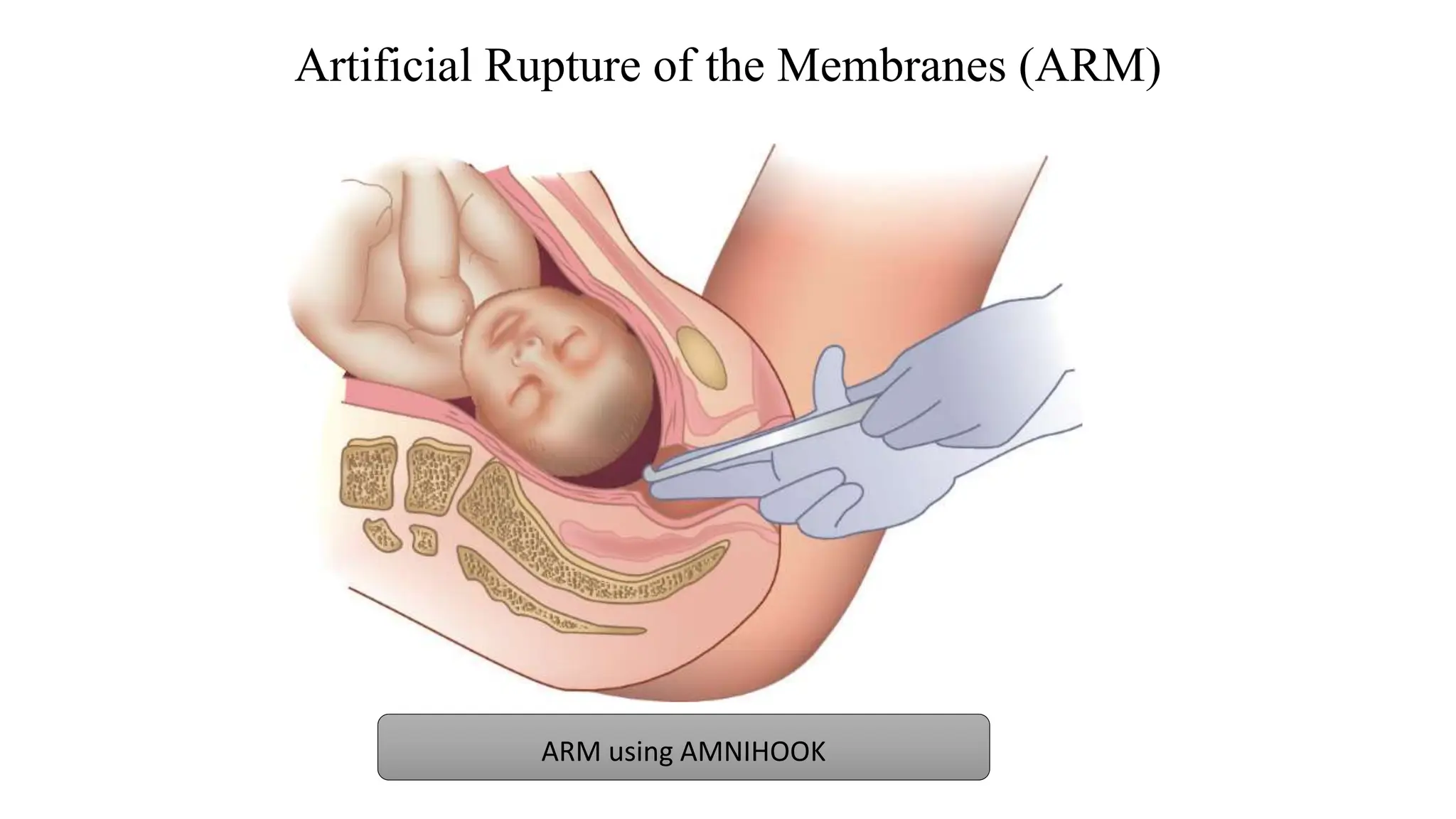 Assisted Rupture Of Membranes Artificial Rupture of Membrane during labor.pptx