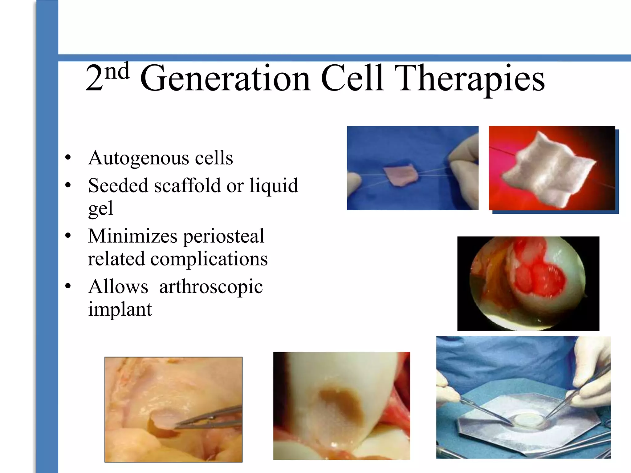 2nd Generation Cell Therapies
• Autogenous cells
• Seeded scaffold or liquid
gel
• Minimizes periosteal
related complications
• Allows arthroscopic
implant
 