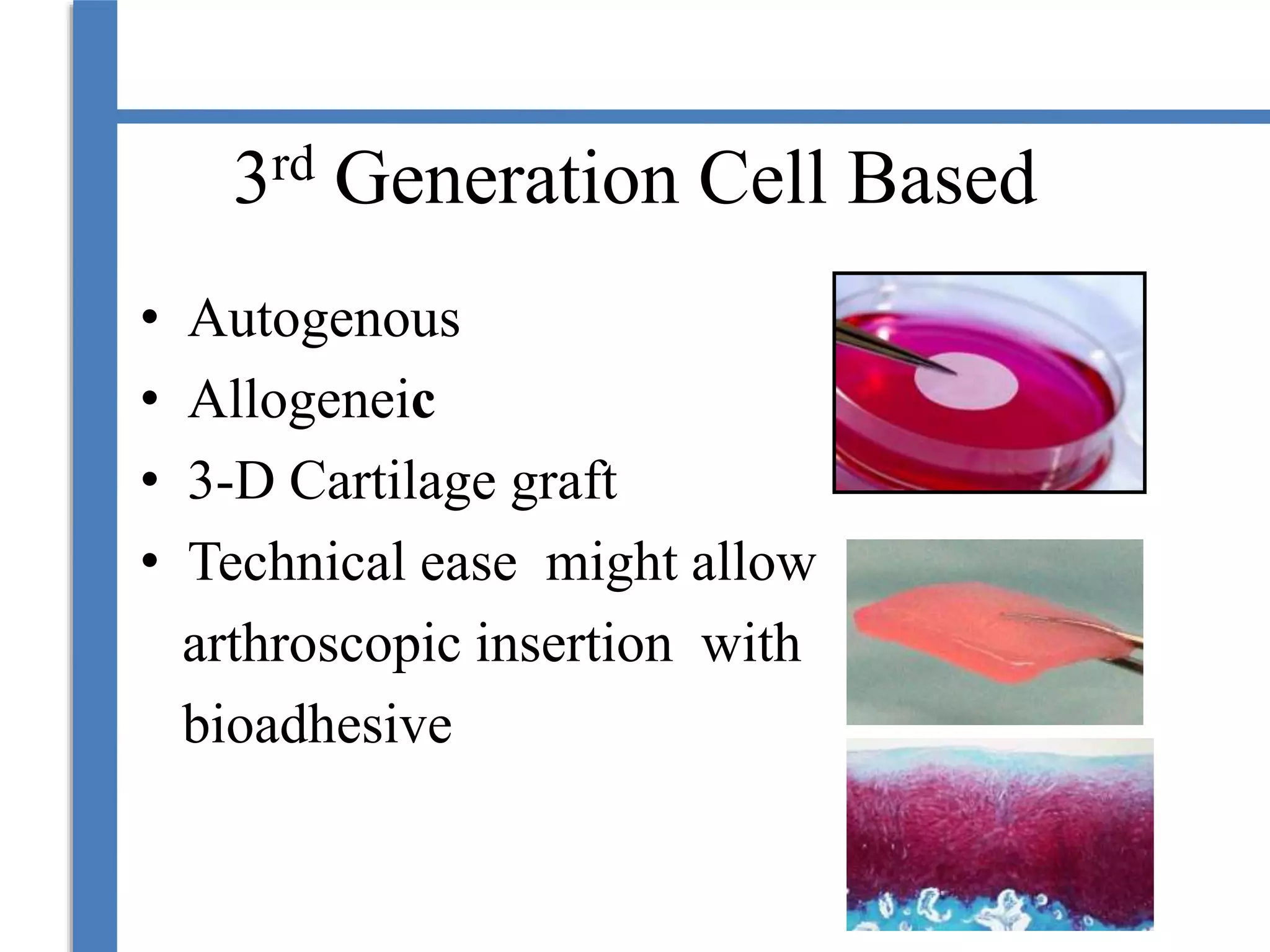 3rd Generation Cell Based
• Autogenous
• Allogeneic
• 3-D Cartilage graft
• Technical ease might allow
arthroscopic insertion with
bioadhesive
 
