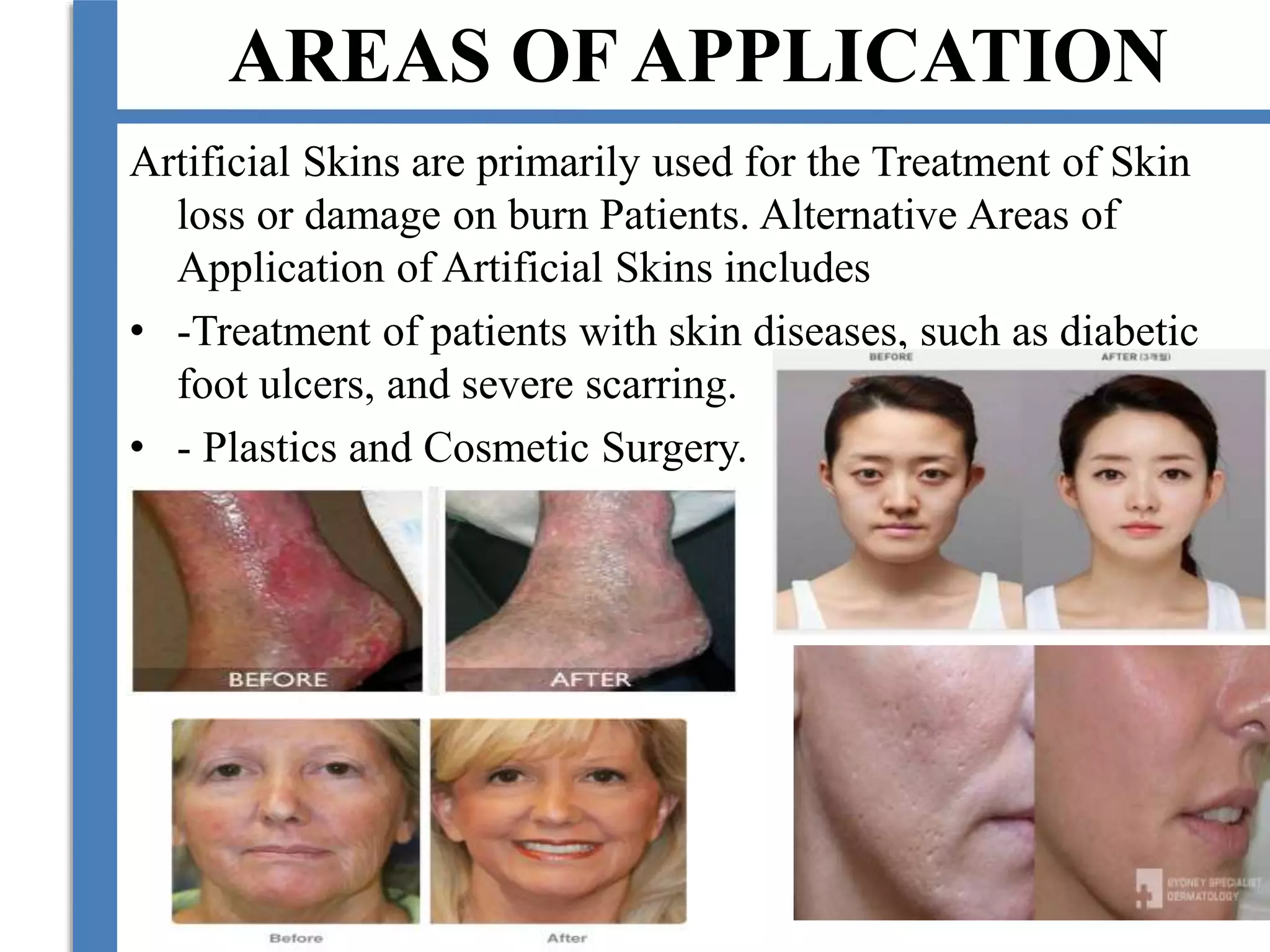 AREAS OF APPLICATION
Artificial Skins are primarily used for the Treatment of Skin
loss or damage on burn Patients. Alternative Areas of
Application of Artificial Skins includes
• -Treatment of patients with skin diseases, such as diabetic
foot ulcers, and severe scarring.
• - Plastics and Cosmetic Surgery.
 
