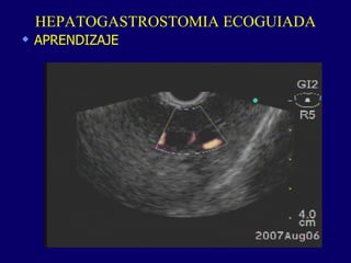 HEPATOGASTROSTOMIA ECOGUIADA APRENDIZAJE 