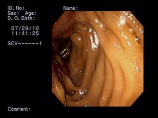 COLEDOCODUODENOSTOMIA 