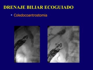 Coledocoantrostomia DRENAJE BILIAR ECOGUIADO  