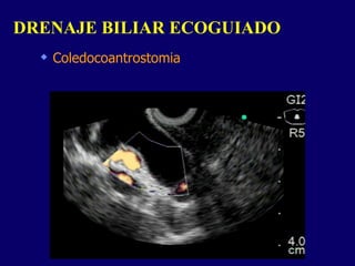 Coledocoantrostomia DRENAJE BILIAR ECOGUIADO  