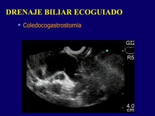 Coledocogastrostomia DRENAJE BILIAR ECOGUIADO  