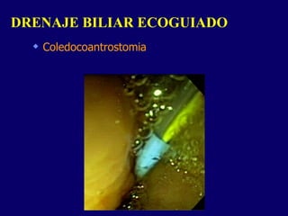 Coledocoantrostomia DRENAJE BILIAR ECOGUIADO  