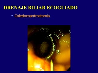 Coledocoantrostomia DRENAJE BILIAR ECOGUIADO  