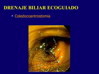 Coledocoantrostomia DRENAJE BILIAR ECOGUIADO  