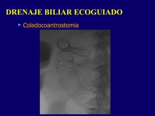 Coledocoantrostomia DRENAJE BILIAR ECOGUIADO  