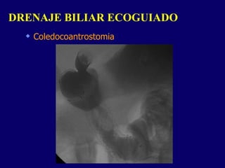 Coledocoantrostomia DRENAJE BILIAR ECOGUIADO  