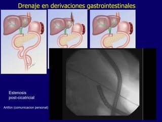 Drenaje en derivaciones gastrointestinales Estenosis post-cicatricial Artifon (comunicacion personal) 