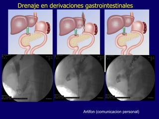 Drenaje en derivaciones gastrointestinales Artifon (comunicacion personal) 
