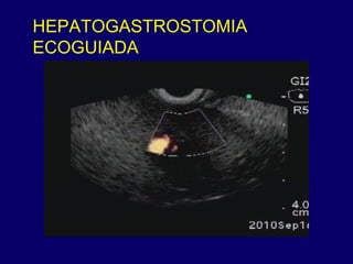 HEPATOGASTROSTOMIA ECOGUIADA 