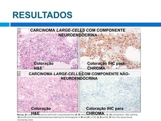 RESULTADOS
Coloração
H&E
Coloração
H&E
Coloração IHC para
CHROMA
Coloração IHC para
CHROMA
CARCINOMA LARGE-CELLS COM COMPONENTE NÃO-
NEUROENDÓCRINA
CARCINOMA LARGE-CELLS COM COMPONENTE
NEUROENDÓCRINA
 