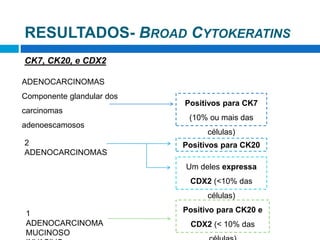 ADENOCARCINOMAS
Componente glandular dos
carcinomas
adenoescamosos
Positivos para CK7
(10% ou mais das
células)
2
ADENOCARCINOMAS
Positivos para CK20
Um deles expressa
CDX2 (<10% das
células)
1
ADENOCARCINOMA
MUCINOSO
Positivo para CK20 e
CDX2 (< 10% das
CK7, CK20, e CDX2
RESULTADOS- BROAD CYTOKERATINS
 