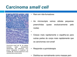 Carcinoma small cell
• Raro em não-fumadores
• Ao microscópio vemos células pequenas
preenchidas quase exclusivamente pelo
núcleo
•
• Cresce mais rapidamente e espalha-se para
outras partes do corpo mais rapidamente que
os carcinomas non-small
• Responde a quimioterapia
• Distribui-se normalmente como massas peri-
Carcinoma small cell. A. As células
tumorais estão densamente
distribuídas, são pequenas, com
pouco citoplasma e ausência de
nucléolo. B. A forma fusiforme é uma
característica proeminente.
 