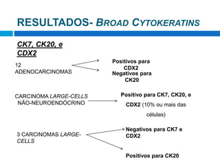 CK7, CK20, e
CDX2
12
ADENOCARCINOMAS
Positivos para
CDX2
Negativos para
CK20
CARCINOMA LARGE-CELLS
NÃO-NEUROENDÓCRINO
Positivo para CK7, CK20, e
CDX2 (10% ou mais das
células)
RESULTADOS- BROAD CYTOKERATINS
3 CARCINOMAS LARGE-
CELLS
Negativos para CK7 e
CDX2
Positivos para CK20
 