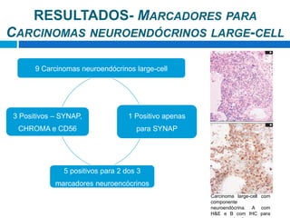 9 Carcinomas neuroendócrinos large-cell
1 Positivo apenas
para SYNAP
5 positivos para 2 dos 3
marcadores neuroencócrinos
3 Positivos – SYNAP,
CHROMA e CD56
Carcinoma large-cell com
componente
neuroendócrina. A com
H&E e B com IHC para
RESULTADOS- MARCADORES PARA
CARCINOMAS NEUROENDÓCRINOS LARGE-CELL
 