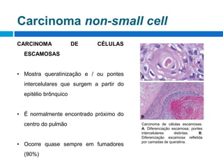 Carcinoma non-small cell
CARCINOMA DE CÉLULAS
ESCAMOSAS
• Mostra queratinização e / ou pontes
intercelulares que surgem a partir do
epitélio brônquico
• É normalmente encontrado próximo do
centro do pulmão
• Ocorre quase sempre em fumadores
(90%)
Carcinoma de células escamosas.
A. Diferenciação escamosa; pontes
intercelulares distintas. B.
Diferenciação escamosa refletida
por camadas de queratina.
 