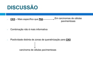 DISCUSSÃO
• CK5 – Mais específico que P63
• Combinação não é mais informativa
• Positividade distinta de zonas de queratinização para CK5
carcinoma de células pavimentosas
Em carcinomas de células
pavimentosas
 