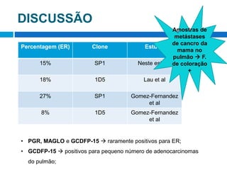 DISCUSSÃO
Percentagem (ER) Clone Estudo
15% SP1 Neste estudo
18% 1D5 Lau et al
27% SP1 Gomez-Fernandez
et al
8% 1D5 Gomez-Fernandez
et al
• PGR, MAGLO e GCDFP-15  raramente positivos para ER;
• GCDFP-15  positivos para pequeno número de adenocarcinomas
do pulmão;
Amostras de
metástases
de cancro da
mama no
pulmão  F.
de coloração
+
 