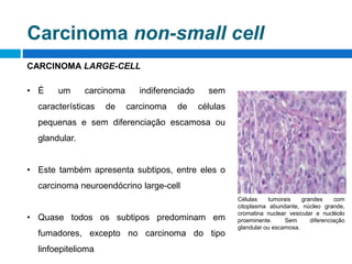 CARCINOMA LARGE-CELL
• É um carcinoma indiferenciado sem
características de carcinoma de células
pequenas e sem diferenciação escamosa ou
glandular.
• Este também apresenta subtipos, entre eles o
carcinoma neuroendócrino large-cell
• Quase todos os subtipos predominam em
fumadores, excepto no carcinoma do tipo
linfoepitelioma
Células tumorais grandes com
citoplasma abundante, núcleo grande,
cromatina nuclear vesicular e nucléolo
proeminente. Sem diferenciação
glandular ou escamosa.
Carcinoma non-small cell
 