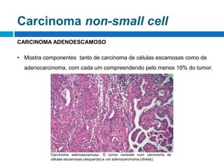CARCINOMA ADENOESCAMOSO
• Mostra componentes tanto de carcinoma de células escamosas como de
adenocarcinoma, com cada um compreendendo pelo menos 10% do tumor.
Carcinoma adenoescamoso. O tumor consiste num carcinoma de
células escamosas (esquerda) e um adenocarcinoma (direita).
Carcinoma non-small cell
 