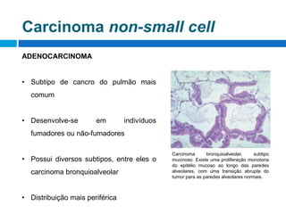 Carcinoma non-small cell
ADENOCARCINOMA
• Subtipo de cancro do pulmão mais
comum
• Desenvolve-se em indivíduos
fumadores o...