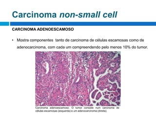 CARCINOMA ADENOESCAMOSO
• Mostra componentes tanto de carcinoma de células escamosas como de
adenocarcinoma, com cada um c...