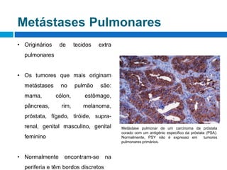 Metástases Pulmonares
• Originários de tecidos extra
pulmonares
• Os tumores que mais originam
metástases no pulmão são:
m...