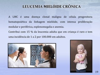 19
A LMC é uma doença clonal maligna de célula progenitora
hematopoiética da linhagem mielóide, com intensa proliferação
medular e periférica, esplenomegalia e anemia.
Contribui com 15 % da leucemia adulta que em criança é raro e tem
uma incidência de 1 a 2 por 100.000 em adultos.
LEUCEMIA MIELÓIDE CRÔNICA
 