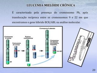 20
É caracterizada pela presença do cromossomo Ph, após
translocação recíproca entre os cromossomos 9 e 22 em que
encontramos o gene híbrido BCR/ABL na análise molecular.
LEUCEMIA MIELÓIDE CRÔNICA
 