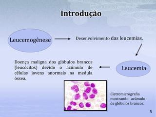 Desenvolvimento das leucemias.
5
Introdução
Leucemogênese
Doença maligna dos glóbulos brancos
(leucócitos) devido o acúmulo de
células jovens anormais na medula
óssea.
Leucemia
Eletromicrografia
mostrando acúmulo
de glóbulos brancos.
 