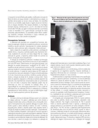 Rev Assoc Med Bras 2008; 54(5): 455-60 457
ATELECTASIAS EM PEDIATRIA: MECANISMOS, DIAGNÓSTICO E TRATAMENTO
o transporte normal de fluídos pelo epitélio, modificando a remoção de
fluído do edema do espaço alveolar e, adicionalmente ao colapso, os
pulmões derrecrutados se tornam cheios de fluídos. Os neutrófilos
aderem-se ao endotélio capilar lesado e migram através do interstício
para os espaços alveolares. Nos espaços alveolares, os macrófagos
secretam citocinas, interleucinas (IL-1,-6,-8 e -10) e fator de necrose
tumoral alfa (TNF-alfa), que agem no local para estimular a quimiotaxia
e ativar os neutrófilos. A IL-1 pode estimular a produção de matriz
extracelular pelos fibroblastos. Os neutrófilos podem liberar substân-
cias oxidantes, proteases, leucotrienos e outras moléculas pró-
inflamatórias como o fator ativador de plaquetas6
.
Consequências funcionais
A atelectasia está associada com conseqüências funcionais: alte-
ração da oxigenação, redução da complacência pulmonar, aumento da
resistência vascular pulmonar, hiperexpansão de unidades alveolares
adjacentes, edema pulmonar após a reexpansão e lesão pulmonar7
.
Após o colapso de um segmento ou lobo pulmonar, a ventilação do
alvéolo diminui, enquanto a perfusão poderá estar levemente dimi-
nuída, resultando em uma área com baixa relação V/Q. Se a região
obstruída for grande, a hipoxemia poderá resultar do aumento da
mistura venosa pelo shunt intrapulmonar3
.
A redução da complacência pulmonar é resultado da diminuição
dos volumes pulmonares, decorrente do início de um ciclo ventilatório
com uma CRF menor. Determinando um maior gasto de energia, com
alteração da pressão transpulmonar, resultando em VC menor3
. A
resistência vascular pulmonar é mínima na CRF, o aumento do volume
pulmonar resulta em compressão alveolar, decorrente do estiramento
do tecido pulmonar. A queda do volume abaixo da CRF resulta em
compressão dos vasos extra-alveolares. A hipóxia no local da atelectasia
é um dos mecanismos que aumenta a resistência vascular pulmonar,
devido a redução da tensão de O2
alveolar e venosa mista2
. Outro
efeito do segmento colapsado é a distensão do alvéolo adjacente não
obstruído. Esta hiperdistensão compensatória pode ser proeminente
no raio-x de tórax e pequenas áreas colapsadas podem não ser
observadas ao raio-x ou evidentes na avaliação clínica. Se a
hiperinsuflação for uma observação proeminente no raio-x, pode ser
difícil determinar se a alteração primária é a atelectasia ou o enfisema,
especialmente em recém-nascidos, nos quais as malformações congê-
nitas com hipertransparência pulmonar são possíveis.
Avaliação
Os sinais e sintomas da obstrução brônquica variam com a extensão
do colapso pulmonar. Em geral, a atelectasia que ocorre durante a
evolução da tuberculose, asma,ou infecções como a bronquiolite, bron-
quite e broncopneumonia não ocasionam alteração no quadro clínico,
exceto quando a aérea obstruída é extensa. Os sinais e sintomas,
taquipnéia,tosse, estridor e dispnéia podem estar presentes devido à
redução da areação do pulmão associada à obstrução7
. Ocasionalmente,
um chiado constante e localizado, a diminuição do murmúrio vesicular e
a alteração da ressonância à percussão local sugerem atelectasia. Pode ser
observada uma diminuição da expansão da caixa torácica, contração da
musculatura e aproximação das costelas acima da área de atelectasia. No
raio-x de tórax, o desvio do coração e do mediastino e a elevação do
diafragma são observadas para o mesmo lado da atelectasia (Figura 1) em
colapsos extensos, mas em recém-nascidos e lactentes pode ser obser-
vado mesmo em colapsos menores8
.
A atelectasia pulmonar é um sinal de doença, de forma isolada não
é sugestiva de um diagnóstico específico. Quando identificada, o
diagnóstico diferencial deve ser considerado e o exame mais útil e
freqüentemente utilizado é o raio-x de tórax.
A atelectasia lobar ou segmentar é representada como opacificação
do lobo ou segmento pulmonar9
. Geralmente, os sinais de atelectasia
referem-se à perda de volume de ar/gás. O sinal mais direto é o
deslocamento da fissura interlobar. Outros sinais de perda de volume,
como o desvio do mediastino (Figura 1) e aumento do hemidiafragma,
são máximos perto do ponto da perda de volume. Pode haver
hiperinsuflação compensatória, nos segmentos aerados remanescentes
no lobo afetado, e a porção colapsada do pulmão demonstra o
aumento da opacidade, sendo freqüentemente triangulares. Entretan-
to, a habilidade do raio-x de detectar a atelectasia que ocorre durante
a anestesia ou durante o uso de VPM é menos acurada10,11
.
A tomografia axial computadorizada (TAC) é o exame preferido
para avaliar os pulmões, devido a sua resolução, velocidade e alta
relação sinal/ruído. Nas imagens convencionais de TAC é possível
medir os volumes pulmonares totais e regionais, a distribuição da
areação pulmonar e o recrutamento em várias condições e interven-
ções clínicas12
. Na TAC de tórax, a atelectasia pode freqüentemente
ser identificada pelos sinais de perda de volume, quando se utiliza o
contraste, a atelectasia resulta em uma atenuação relativamente eleva-
da do parênquima pulmonar, um achado útil para distinguir a atelectasia
dos processos de consolidação (pneumonia), em que há uma ate-
nuação relativamente baixa. A ressonância magnética (RM) permite a
obtenção de imagens tridimensionais sem a utilização de irradiação
Figura 1 - Atelectasia de lobo superior direito do pulmão de uma criança
de seis meses de idade ao raio-x de tórax (incidência ântero-posterior).
Observe o desvio do mediastino para o lado do colapso pulmonar.
 