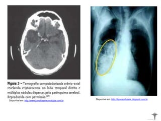 Disponível em: http://tiponaochateis.blogspot.com.br
Disponível em: http://www.jornaldepneumologia.com.br
 