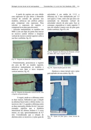 Montagem. de mod. de est. em art. semi-ajustável. Fernandes Neto , A. J. et al. Univ. Fed. Uberlândia - 2005 135
A partir do registro em cera obtido
com espessura tal que altera a dimensão
vertical de oclusão do paciente nos
modelos, utiliza-se um artifício prático
para compensar esta espessura. Para
calcular a espessura do registro e
compensá-la no pino guia devemos:
- Articular manualmente os modelos em
MIH e com um lápis de ponta fina marcar
no incisivo central inferior o trespasse
vertical do incisivo central superior sobre a
sua face vestibular, fig. 41.
Fig. 41 - Registro da dimensão vertical em MIH
- Posteriormente, posiciona-se o registro
em cera da RC no modelo superior,
articula-se manualmente os modelos e
marca-se com lápis o novo trespasse
vertical anterior, fig. 42.
Fig. 42 - Registro da dimensão vertical em RC com
o registro em posicionado.
A seguir, mede-se a diferença entre
as duas marcas. Sabendo-se que a relação
na abertura bucal entre o último molar e os
incisivos é de 1:3, quando a diferença entre
as duas marcações obtidas for de 2 mm por
exemplo, significa que a distância
interoclusal do últimos molares é 3 vezes
menor, ou seja, aproximadamente de 0,7
mm. Considerando que a relação de
abertura entre os incisivos e o pino guia do
articulador é em média de 1:1,5, a
diferença de 2 mm multiplicada por 1,5
será igual a 3 mm, valor este que deve ser
aumentado na dimensão vertical do
articulador através do pino guia. Isso se
consegue, erguendo-se o ramo superior 3
mm em relação à marca zero do pino guia
(linha contínua), figs 43 e 44.
Fig. 43 - Registro da diferença da dimensão vertical
em MIH e RC com o registro em cera.
Fig. 44 - Ajuste do pino guia do ASA.
Ajusta-se a mesa incisal com o pino
guia apoiado em seu centro, fig. 45.
Fig. 45- Ajuste do pino guia e mesa incisal do
ASA.
 