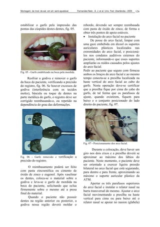 Montagem. de mod. de est. em art. semi-ajustável. Fernandes Neto , A. J. et al. Univ. Fed. Uberlândia - 2005 126
estabilizar o garfo pela impressão das
pontas das cúspides destes dentes, fig. 05.
Fig. 05 - Garfo estabilizado na boca pela mordida.
Resfriar a godiva e remover o garfo
da boca do paciente, verificando a precisão
do registro, fig. 06. Se houver excessos de
godiva (interferência com os tecidos
moles), báscula ou toque de dentes na
parte metálica do garfo, o registro deve ser
corrigido reembasando-o, ou repetido na
dependência do grau das deformações.
Fig. 06 - Garfo removido e verificação a
precisão do registro.
O reembasamento poderá ser feito
com pasta zincoenólica ou cimento de
óxido de zinco e eugenol. Após vaselinar
os dentes, coloca-se o material sobre a
godiva e leva-se o garfo de mordida na
boca do paciente, solicitando que oclua
firmemente sobre o mesmo até a presa
final do material.
Quando o paciente não possuir
dentes na região anterior ou posterior, a
godiva nessa região deverá moldar o
rebordo, devendo ser sempre reembasada
com pasta de óxido de zinco, de forma a
obter três pontos de apoio estáveis.
• Instalação do arco facial no paciente
De posse do arco facial, limpar com
uma gaze embebida em álcool os suportes
auriculares plásticos localizados nas
extremidades do arco facial, e posicioná-
los nos condutos auditivos externos do
paciente, informando-o que esses suportes
ampliarão os ruídos causados pelos ajustes
do arco facial.
Pedir ao paciente que segure com firmeza
ambos os braços do arco facial e ao mesmo
tempo conecta-se a presilha localizada na
haste vertical do arco facial ao cabo do
garfo. Nesta operação deve-se certificar
que a presilha fique por cima do cabo do
garfo, de tal forma que os parafusos de
ajuste, quando existirem, fiquem para
baixo e o conjunto posicionado do lado
direito do paciente, fig. 07.
Fig. 07 - Posicionamento dos arco facial.
Durante a colocação, deve haver um
giro nos dois eixos e a presilha deverá se
aproximar ao máximo dos lábios do
paciente. Neste momento, o paciente deve
ser orientado a exercer ligeira pressão
bilateral no arco facial que está segurando,
para dentro e para frente, aproximando ao
máximo o suporte auricular plástico da
ATM.
Apertar os três parafusos superiores
do arco facial e instalar o relator nasal na
barra transversal do mesmo. Ajustar o arco
facial movimentando a presilha na haste
vertical para cima ou para baixo até o
relator nasal se apoiar no nasion (glabela)
 