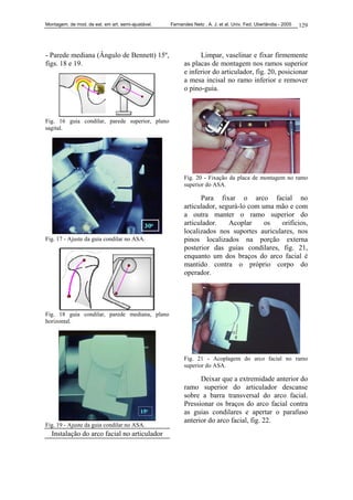 Montagem. de mod. de est. em art. semi-ajustável. Fernandes Neto , A. J. et al. Univ. Fed. Uberlândia - 2005 129
- Parede mediana (Ângulo de Bennett) 15º,
figs. 18 e 19.
Fig. 16 guia condilar, parede superior, plano
sagital.
Fig. 17 - Ajuste da guia condilar no ASA.
Fig. 18 guia condilar, parede mediana, plano
horizontal.
Fig. 19 - Ajuste da guia condilar no ASA.
Instalação do arco facial no articulador
Limpar, vaselinar e fixar firmemente
as placas de montagem nos ramos superior
e inferior do articulador, fig. 20, posicionar
a mesa incisal no ramo inferior e remover
o pino-guia.
Fig. 20 - Fixação da placa de montagem no ramo
superior do ASA.
Para fixar o arco facial no
articulador, segurá-lo com uma mão e com
a outra manter o ramo superior do
articulador. Acoplar os orifícios,
localizados nos suportes auriculares, nos
pinos localizados na porção externa
posterior das guias condilares, fig. 21,
enquanto um dos braços do arco facial é
mantido contra o próprio corpo do
operador.
Fig. 21 - Acoplagem do arco facial no ramo
superior do ASA.
Deixar que a extremidade anterior do
ramo superior do articulador descanse
sobre a barra transversal do arco facial.
Pressionar os braços do arco facial contra
as guias condilares e apertar o parafuso
anterior do arco facial, fig. 22.
 