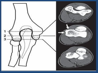 Artigo epicondilite lateral