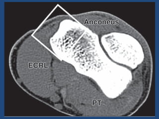 Artigo epicondilite lateral