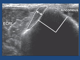 Artigo epicondilite lateral