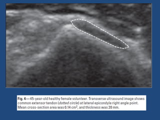 Artigo epicondilite lateral